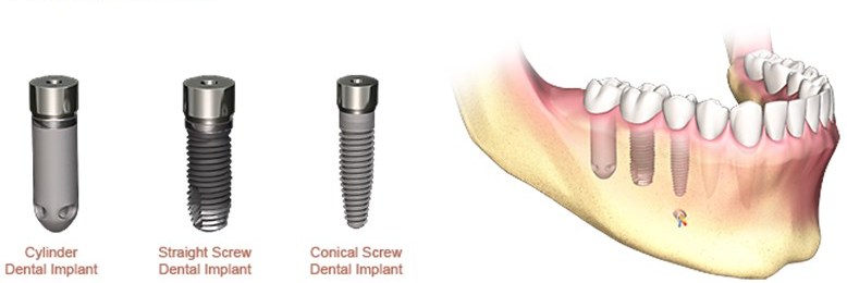 factory on All kinds of Tipuri de implanturi dentare - Implantodent