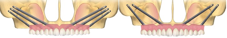 implanturi si tipuri de lucrari4