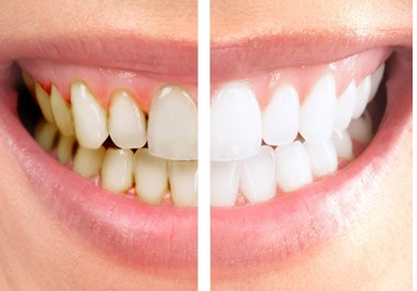 Igienizarea dentara profesionala10