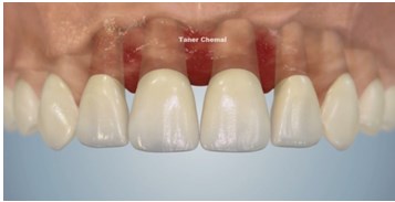 Igienizarea dentara profesionala2