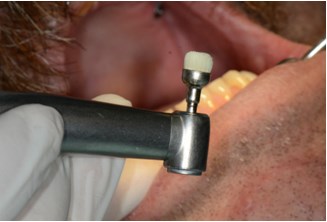 Igienizarea dentara profesionala6