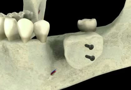 Zonă laterală de mandibulă cu volum osos refăcut printr-un bloc osos fixat cu două șuruburi de osteosinteză