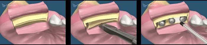 Elongarea orizontală de creastă („ridge splitting”): creasta subțiată, secționarea pe mijloc cu instrument piezo și inserarea implanturilor între fragmentele dilatate
