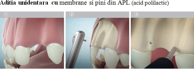 Primele trei etape ale adiției unidentare cu membrane și pini din acid polilactic, în zona frontală