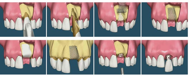 Augmentare unidentară susținută cu plasă din titan: extracția dintelui, montarea plasei peste materialul de adiție și inserarea implantului după regenerarea osului