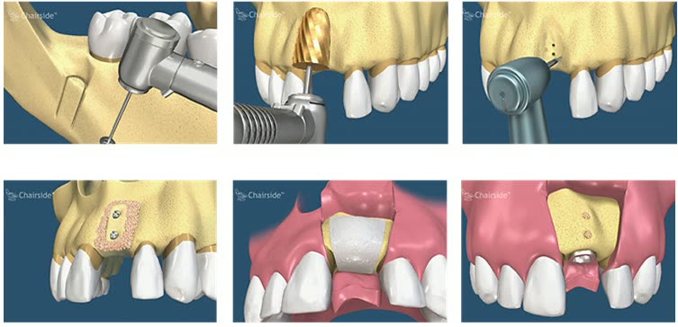Augmentare unidentară cu autogrefă: recoltarea fragmentului osos intraoral, fixarea lui cu șuruburi din titan în zona deficitară și acoperirea cu gingie
