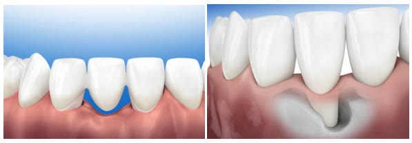 Spațiu vizibil apărut sub o lucrare dentară din cauza retragerii gingiei și a defectului osos de dedesubt