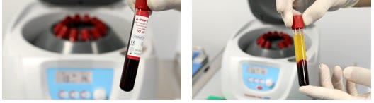 Prepararea PRF în clinică: eprubeta cu sângele recoltat de la pacient, înainte și după centrifugare, cu straturile separate