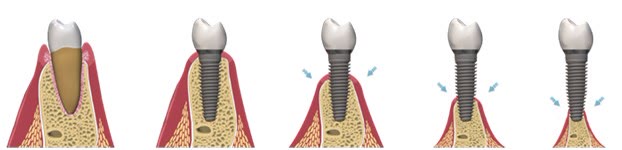 Implant dentar cu coroană în os sănătos și, în stadii succesive, pierderea osului din jurul implantului până la expunerea acestuia