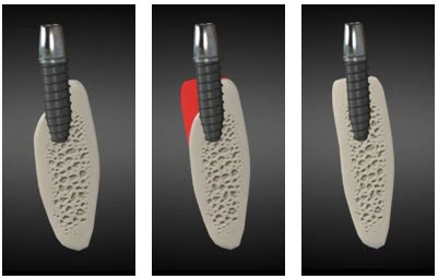 Implant inserat imediat după extracție: spațiul rămas între implant și pereții alveolei, umplerea acestuia cu substitut osos și osul vindecat în jurul implantului
