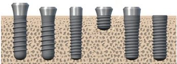 Implanturi dentare de lungimi diferite inserate în os, inclusiv un implant scurt și lat
