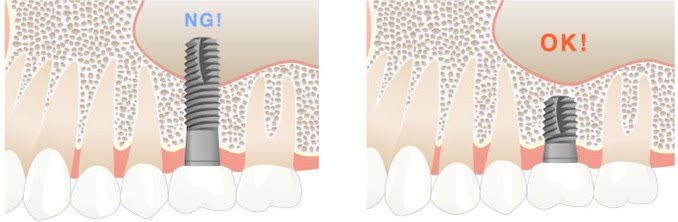 Comparație: implant lung care ar pătrunde în sinusul maxilar, marcat „NG!”, față de implantul scurt corect plasat sub sinus, marcat „OK!”