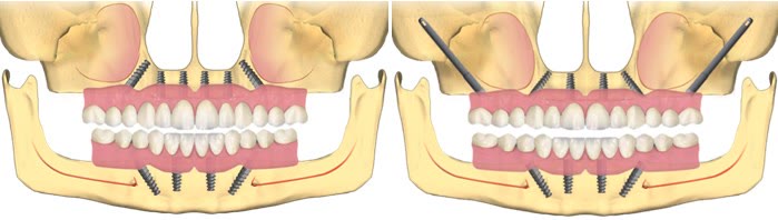 Schemă cu implanturi dentare inserate la maxilar și la mandibulă, comparativ cu varianta cu implanturi angulate ancorate în zonele cu os disponibil