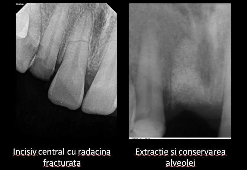 Două radiografii digitale alăturate: incisiv central cu rădăcina fracturată și, după intervenție, alveola conservată cu biomaterial de grefare