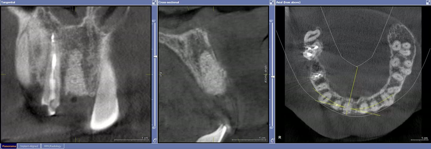 Tomografie dentară după extracția dintelui fracturat, cu alveola conservată și volumul osos păstrat, în secțiuni tangențială, transversală și axială