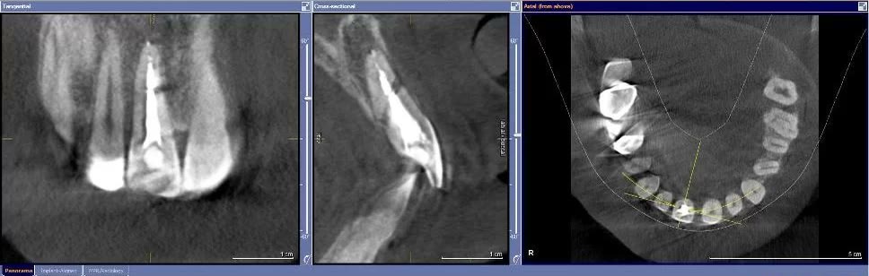 Tomografie dentară în trei planuri — tangențial, transversal și axial — cu linia de fractură a rădăcinii vizibilă tridimensional