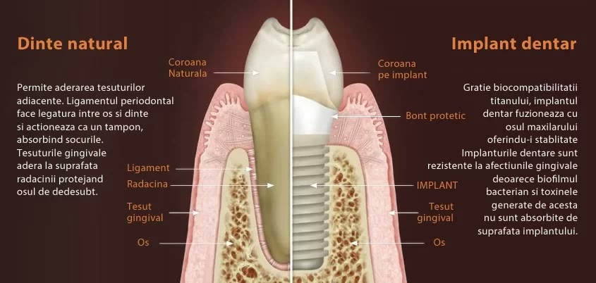 Comparație în secțiune între un dinte natural și un implant dentar: coroană, bont protetic, implant, țesut gingival și os