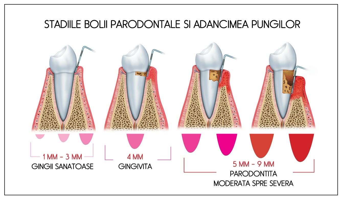Stadiile bolii parodontale și adâncimea pungilor: gingii sănătoase, gingivită, parodontită moderată spre severă