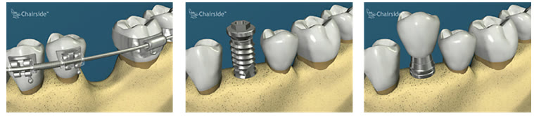 Repoziționarea orizontală a osului: dintele sănătos este deplasat ortodontic în zona cu os deficitar, iar în locul rămas, cu os integru, se inseră un implant dentar