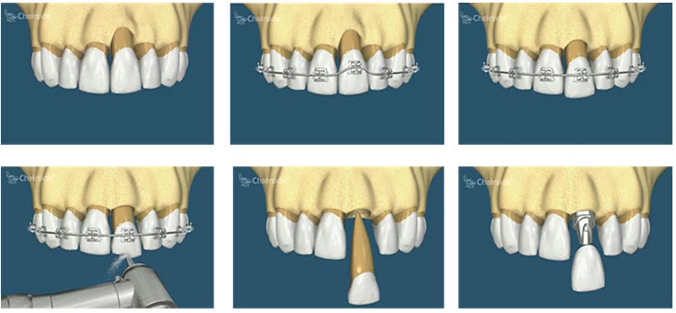 Etapele repoziționării verticale a osului: defect osos la un incisiv, tracționarea dintelui cu aparat ortodontic fix, scurtarea coroanei, extracția și înlocuirea cu implant dentar
