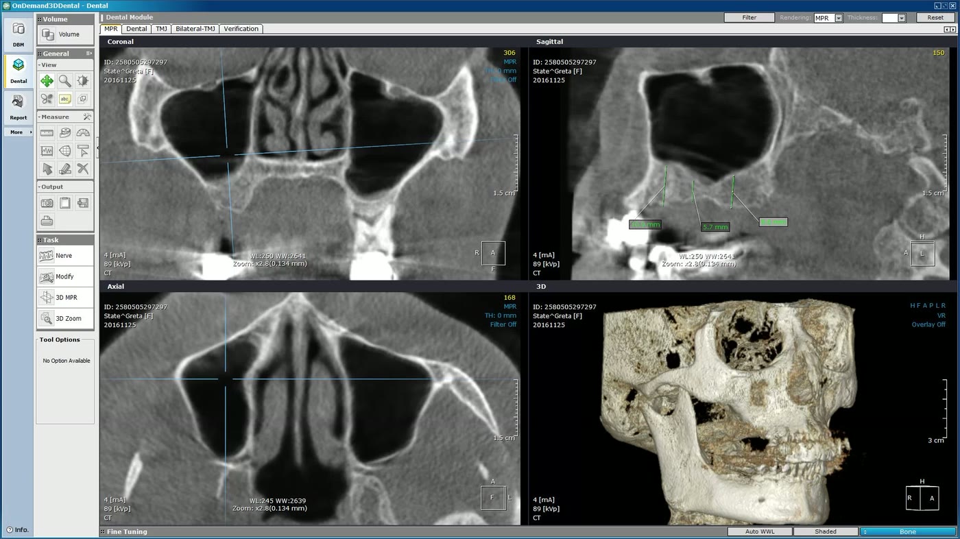 Măsurători pe tomografia dentară pentru sinus lifting: secțiuni coronală, sagitală, axială și reconstrucție 3D a sinusurilor maxilare