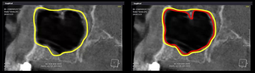 Aceeași secțiune sagitală cu conturul osului trasat cu galben și conturul mucoasei sinuzale trasat cu roșu