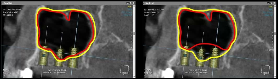 Implanturi planificate virtual care ar depăși limita osului și ar atinge mucoasa sinuzală conturată cu roșu