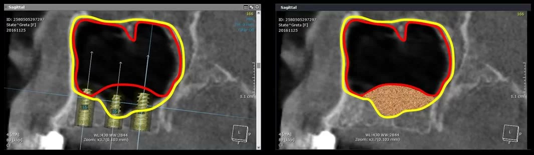 Simulare a spațiului de sub membrana sinuzală umplut cu biomaterial, care va susține regenerarea osoasă în jurul implanturilor