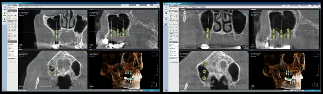 Două ecrane de planificare tridimensională a implanturilor pe tomografia dentară cu fascicul conic