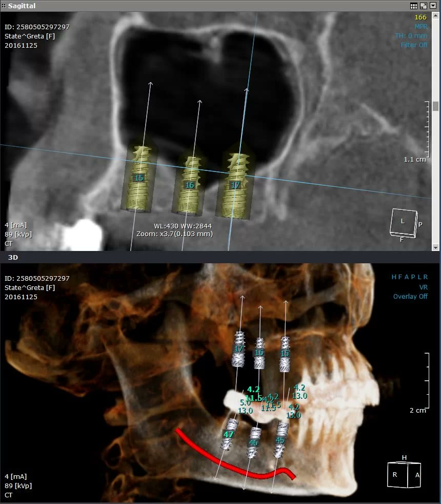 Planificarea implanturilor în zona laterală maxilară: secțiune sagitală și reconstrucție 3D cu pozițiile, diametrele și lungimile implanturilor