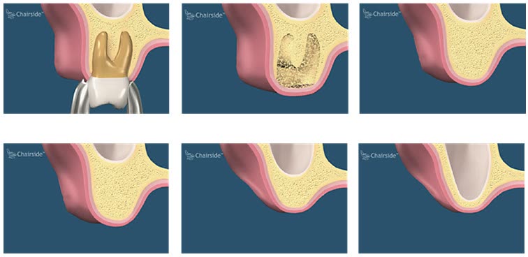 Expandarea sinusului maxilar în timp, după extracția unui dinte lateral superior neînlocuit cu implant