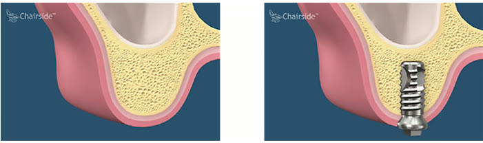 Creastă osoasă cu înălțime suficientă sub sinusul maxilar și implant standard inserat fără augmentare sinuzală