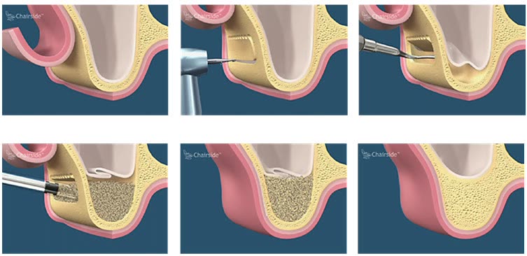 Etapele sinus liftingului extern: crearea ferestrei laterale în os, ridicarea membranei sinuzale, umplerea cu material de adiție și acoperirea cu gingie