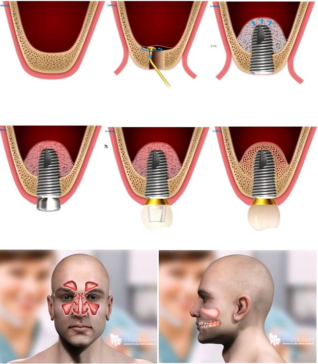 Sinus lifting intern cu implantare, restaurarea protetică pe implant și reprezentarea anatomică a sinusurilor pe față și în profil