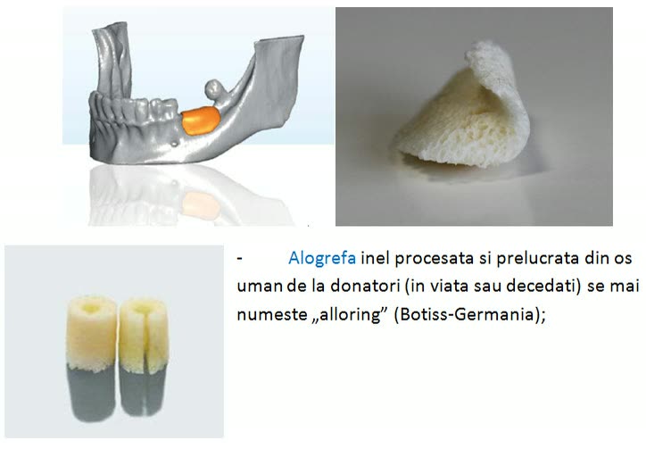 Alogrefă monobloc prelucrată CAD/CAM pe forma defectului osos mandibular și alogrefă de tip inel („alloring”) din os uman procesat