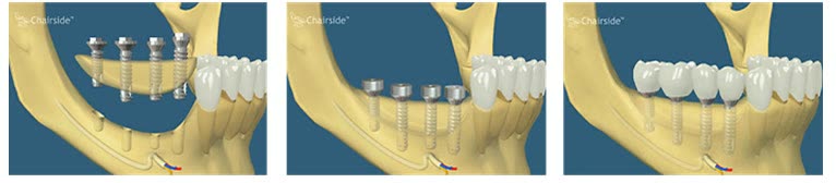 Bloc osos fixat la mandibulă chiar cu ajutorul implanturilor dentare, apoi lucrarea protetică finalizată