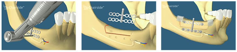 Osteodistracție la mandibulă: secționarea fragmentului osos superior, montarea distractorului și elongarea verticală a crestei