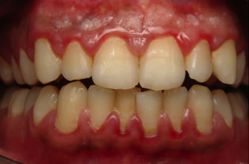 Gingie inflamată, înroșită și umflată în jurul dinților frontali — aspect de gingivită