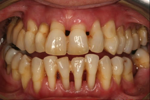 Retracție gingivală avansată, cu rădăcini expuse și spații apărute între dinți — aspect de parodontită