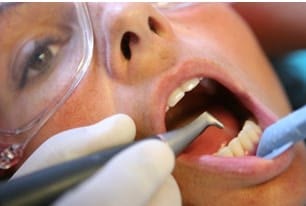 Igienizare dentară profesională în cabinet, cu instrumentar de detartraj