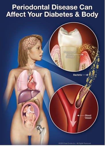 Planșă medicală care arată cum boala parodontală și bacteriile din gingie afectează diabetul și restul organismului