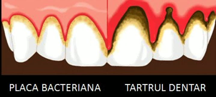 Comparație între placa bacteriană depusă la marginea gingiei și tartrul dentar întărit, cu gingie inflamată