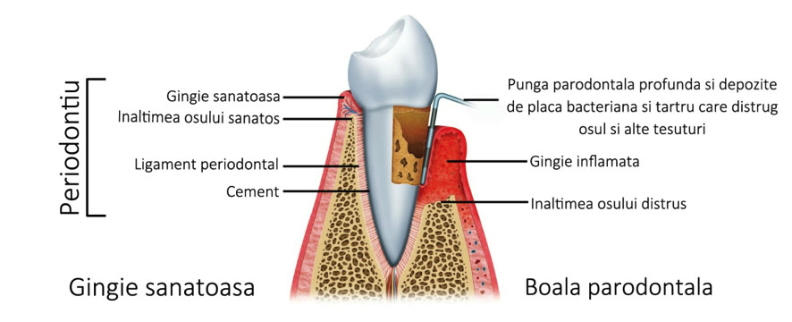 Secțiune comparativă: gingie sănătoasă cu ligament periodontal și os intact, față de boala parodontală cu pungă parodontală profundă, gingie inflamată și înălțimea osului distrusă