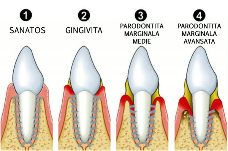 Schemă cu evoluția în patru etape: dinte sănătos, gingivită, parodontită marginală medie și parodontită marginală avansată