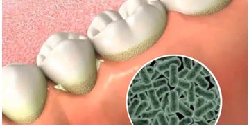 Ilustrație cu depozite de placă bacteriană la marginea gingiei și detaliu mărit al coloniilor de bacterii
