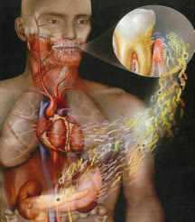 Ilustrație care arată răspândirea bacteriilor de la nivelul unui dinte cu boală parodontală către inimă și organele interne