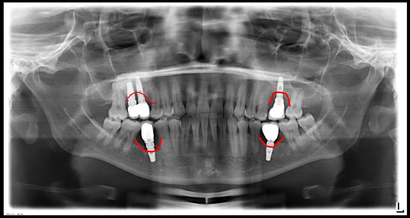 Radiografie panoramică pe care este marcată cu roșu resorbția osoasă verticală din jurul implanturilor afectate de periimplantită