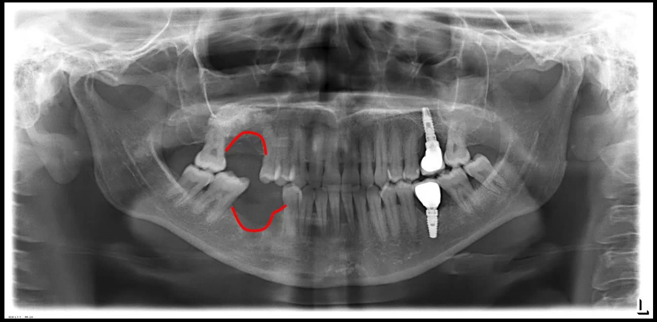 Radiografie panoramică după îndepărtarea implanturilor de pe o hemiarcadă, cu marcaje roșii pe conturul defectului osos rămas