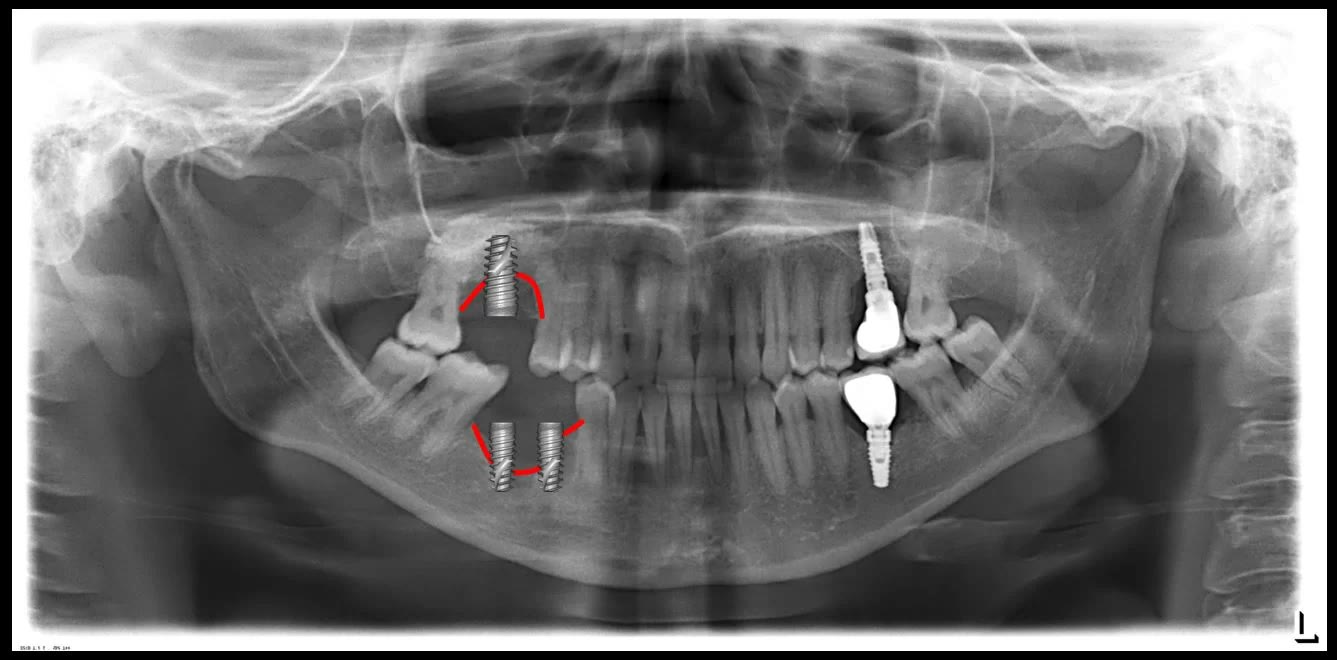 Radiografie panoramică pe care sunt suprapuse grafic viitoarele implanturi, în pozițiile și dimensiunile planificate