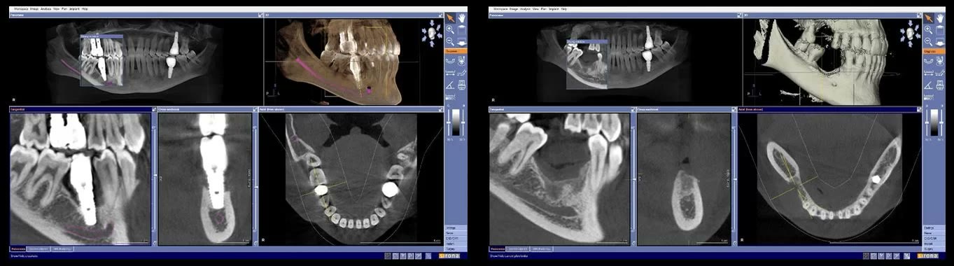 Două capturi din softul de tomografie dentară, comparate: în stânga implantul încă prezent în os, în dreapta alveola rămasă după explantare